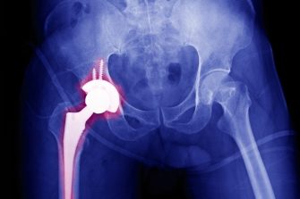 X-ray of a hip bone with the leg joint highlighted