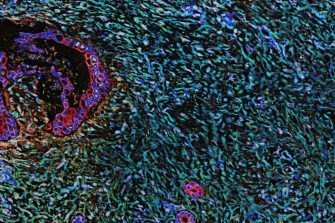 Pancreatic desmoplasia