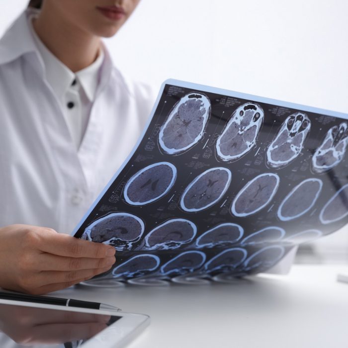 Doctor examining MRI images of patient with multiple sclerosis at table in clinic, closeup
