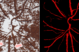 3D reconstruction and visualisation of ocular disease model from OCT images