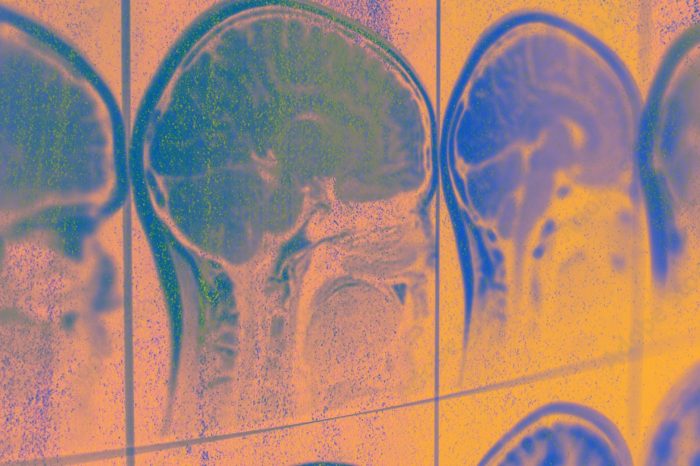 stylised orange image with purple mri scans of human heads