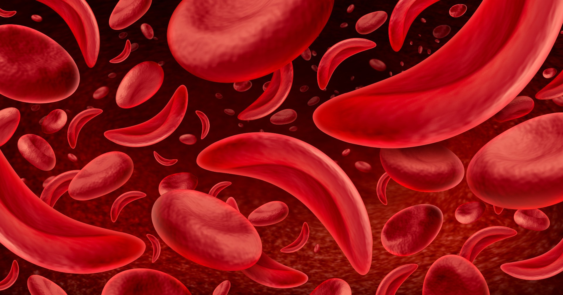 Sickle cell anemia as a red blood disease as a normal and abnormal hemoglobin anatomy medical illustration concept.