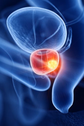 3d rendered medically accurate illustration of prostate cancer