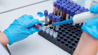 Blood test in the laboratory. Laboratory assistant working with the dispenser. Vacuum tubes with blood.