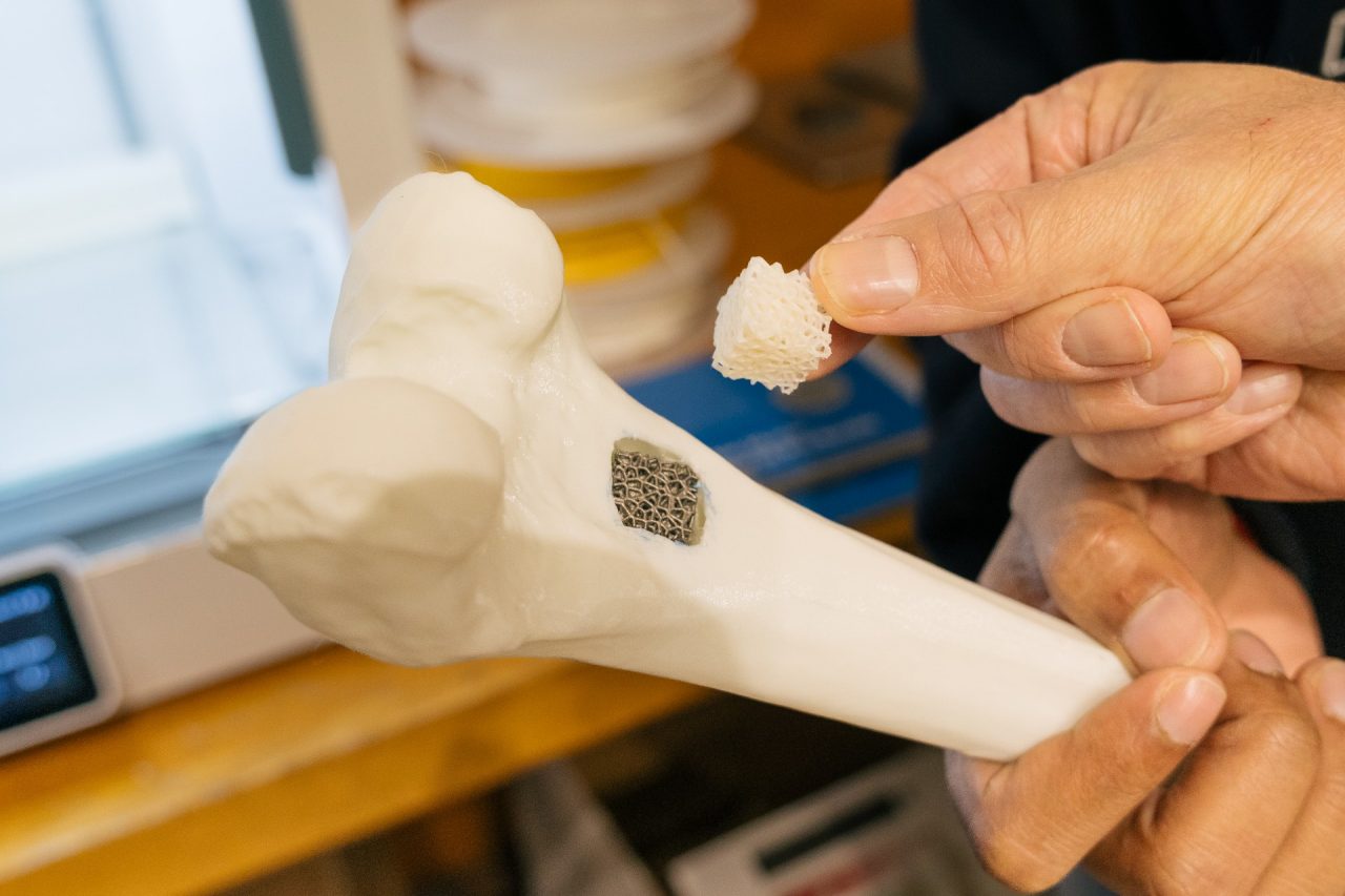 A 3D-printed implant using polylactic acid, a biodegradable polymer, with irregular and randomly designed patterns to better replicate the internal structure of bone to give cells a place to attach and regrow to rebuild tissue.