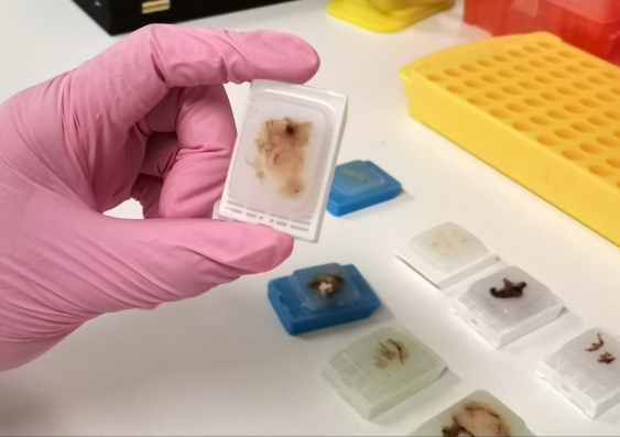 Ovarian Cancer Tumour Gene Test 